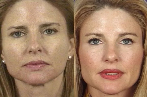 before and after facial rejuvenation front view female patient case 1985