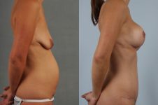 before and after mommy makeover right side view female patient case 1291