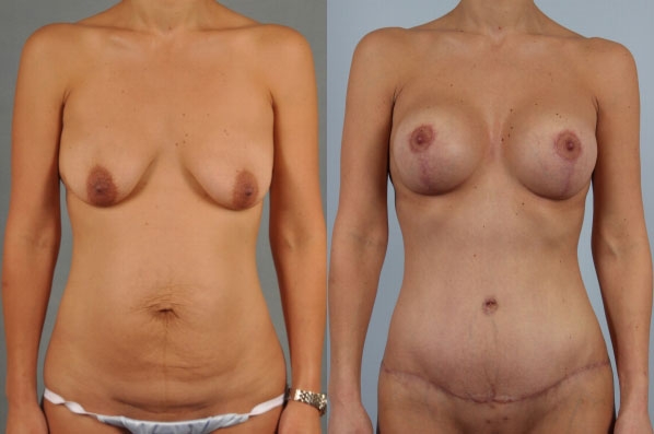 before and after mommy makeover front view female patient case 1291