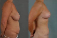 before and after mommy makeover right side view female patient case 1283