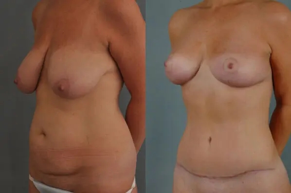 before and after mommy makeover left angle view female patient case 1283