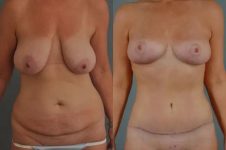 before and after mommy makeover front view female patient case 1283