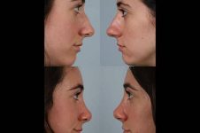 before and after rhinoplasty female patient left and right side view case 3586