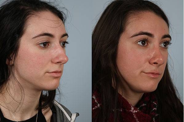 before and after rhinoplasty female patient right diagonal view case 3586