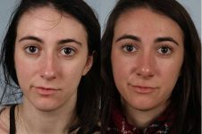 before and after rhinoplasty female patient front view case 3586