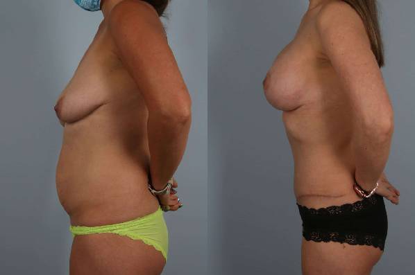 before and after tummy tuck female patient right side view case 4903