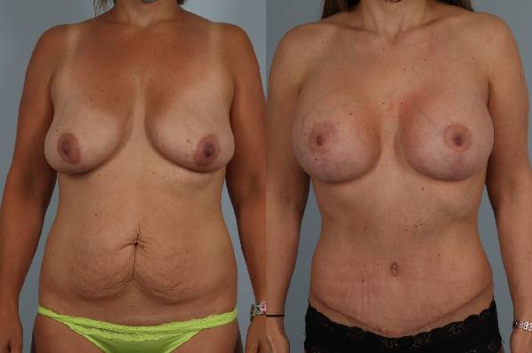 before and after tummy tuck female patient front view case 4903