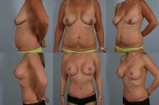 before and after tummy tuck female patient multiple angle view case 4903