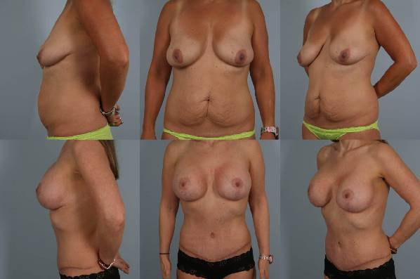 before and after tummy tuck female patient multiple angle view case 4903