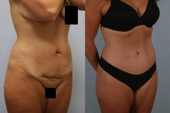 before and after tummy tuck female patient right diagonal view case 4915