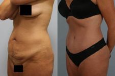 before and after tummy tuck female patient left diagonal view case 4915