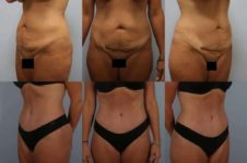 before and after tummy tuck female patient multiple angle view case 4915