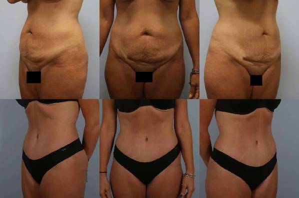 before and after tummy tuck female patient multiple angle view case 4915