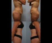 before and after tummy tuck female patient right and left side view case 4915