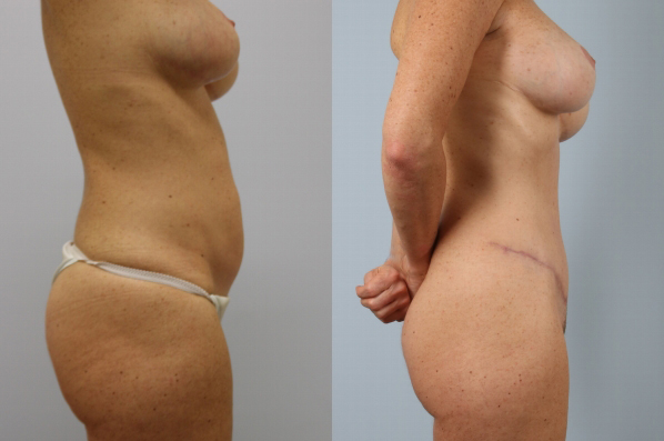 before and after tummy tuck female patient right side view case 4920