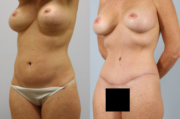 before and after tummy tuck female patient left diagonal view case 4920