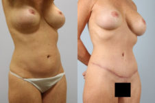 before and after tummy tuck female patient right diagonal view case 4920