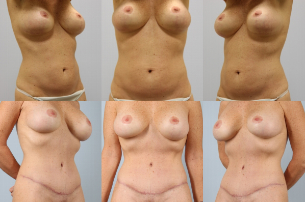 before and after tummy tuck female patient multiple angle view case 4920