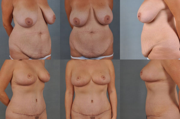 before and after tummy tuck female patient multiple angle view case 5018