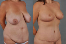 before and after tummy tuck female patient right diagonal view case 5018