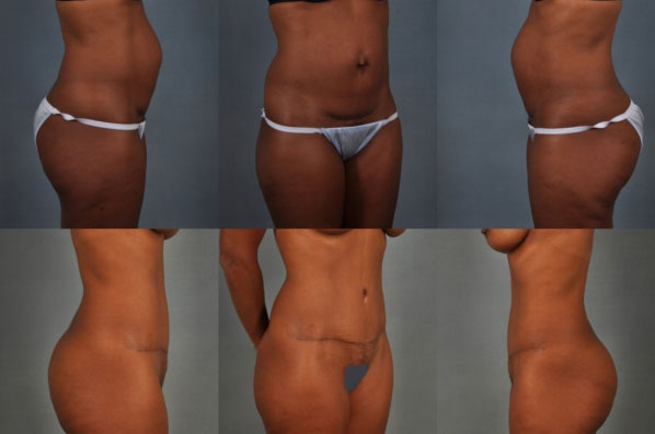 before and after tummy tuck female patient multiple angle view case 5038