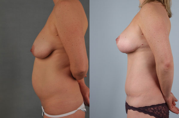 before and after tummy tuck female patient left side view case 5057
