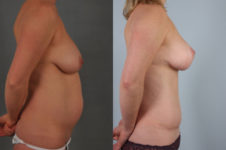before and after tummy tuck female patient right side view case 5057