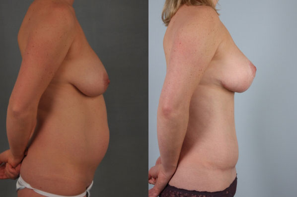 before and after tummy tuck female patient right side view case 5057