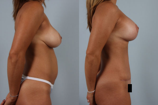 before and after tummy tuck female patient right side view case 5092