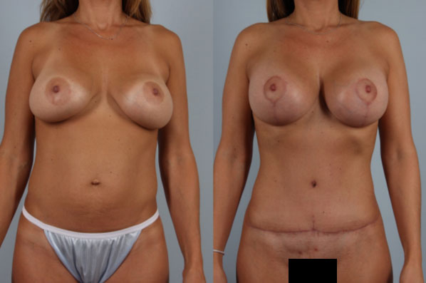 before and after tummy tuck female patient front view case 5092