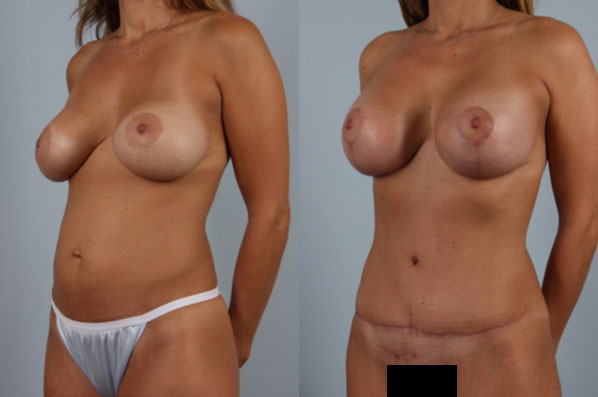 before and after tummy tuck female patient left diagonal view case 5092