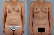 before and after tummy tuck female patient front view case 5096