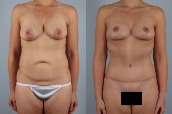 before and after tummy tuck female patient front view case 5096