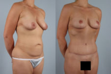 before and after tummy tuck female patient right diagonal view case 5096