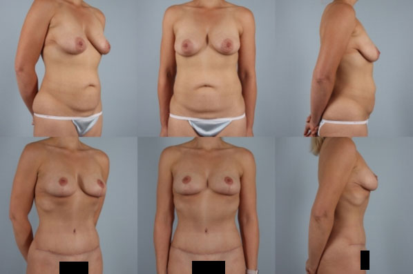 before and after tummy tuck female patient multiple angle view case 5096