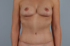 after tummy tuck female patient front view case 5096