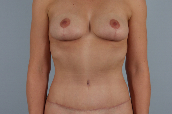 after tummy tuck female patient front view case 5096