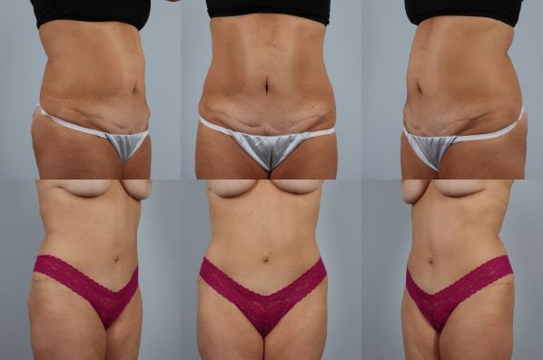 before and after tummy tuck female patient multiple angle view case 5101