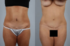 before and after tummy tuck female patient front view case 5101