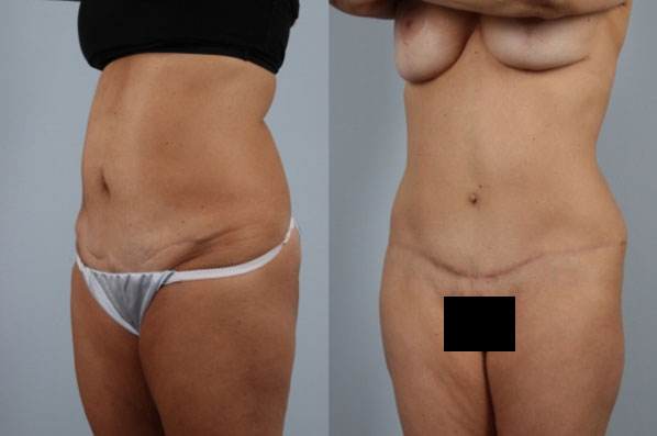 before and after tummy tuck female patient left diagonal view case 5101