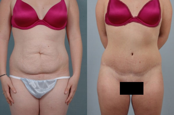 before and after tummy tuck female patient front view case 5110
