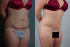 before and after tummy tuck female patient right diagonal view case 5110