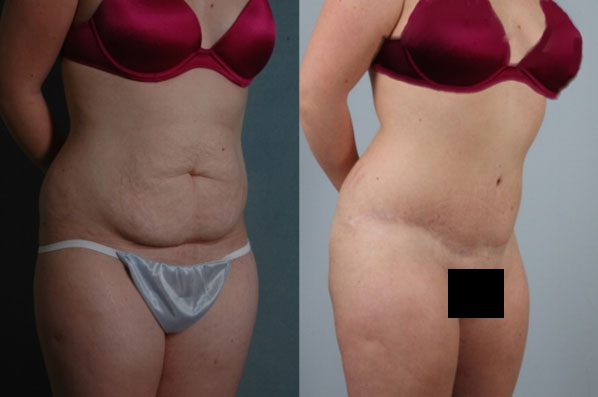 before and after tummy tuck female patient right diagonal view case 5110