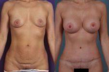 before and after tummy tuck female patient front view case 5118