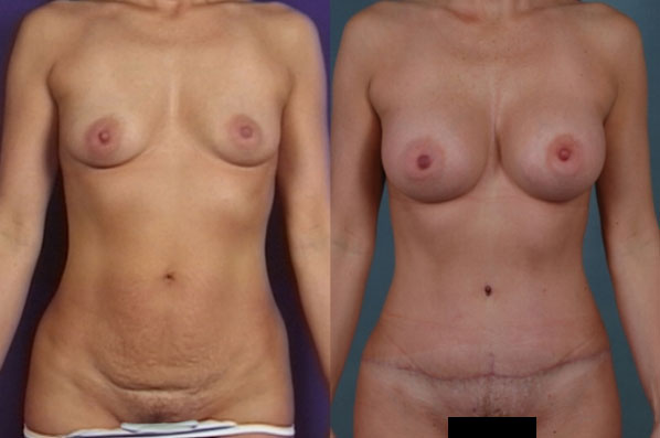 before and after tummy tuck female patient front view case 5118