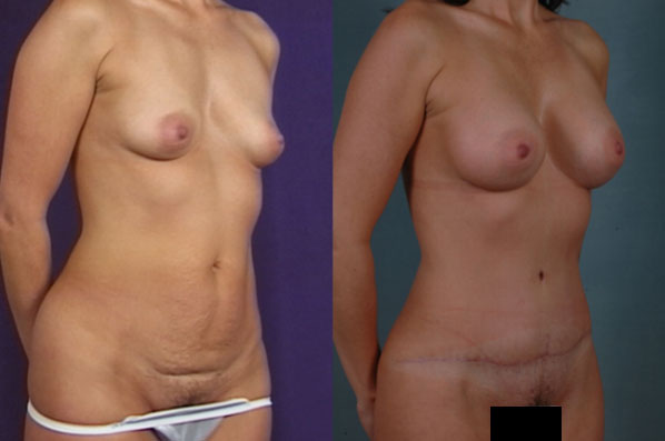 before and after tummy tuck female patient right diagonal view case 5118