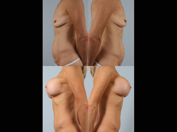 before and after tummy tuck female patient right and left side view case 5124