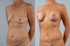 before and after tummy tuck female patient left diagonal view case 5124