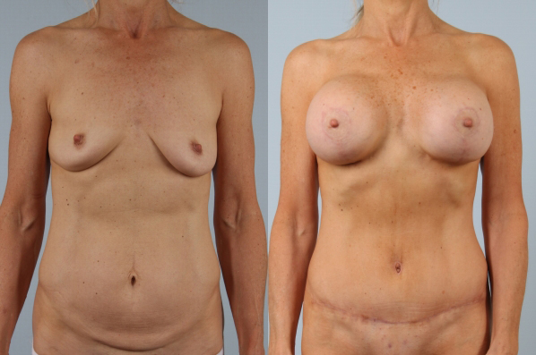 before and after tummy tuck female patient front view case 5124