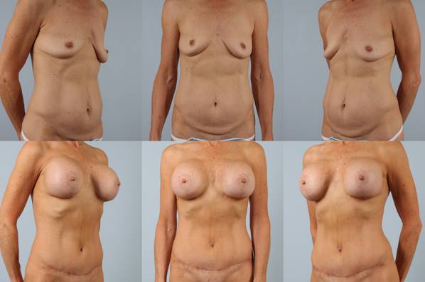 before and after tummy tuck female patient multiple angle view case 5124